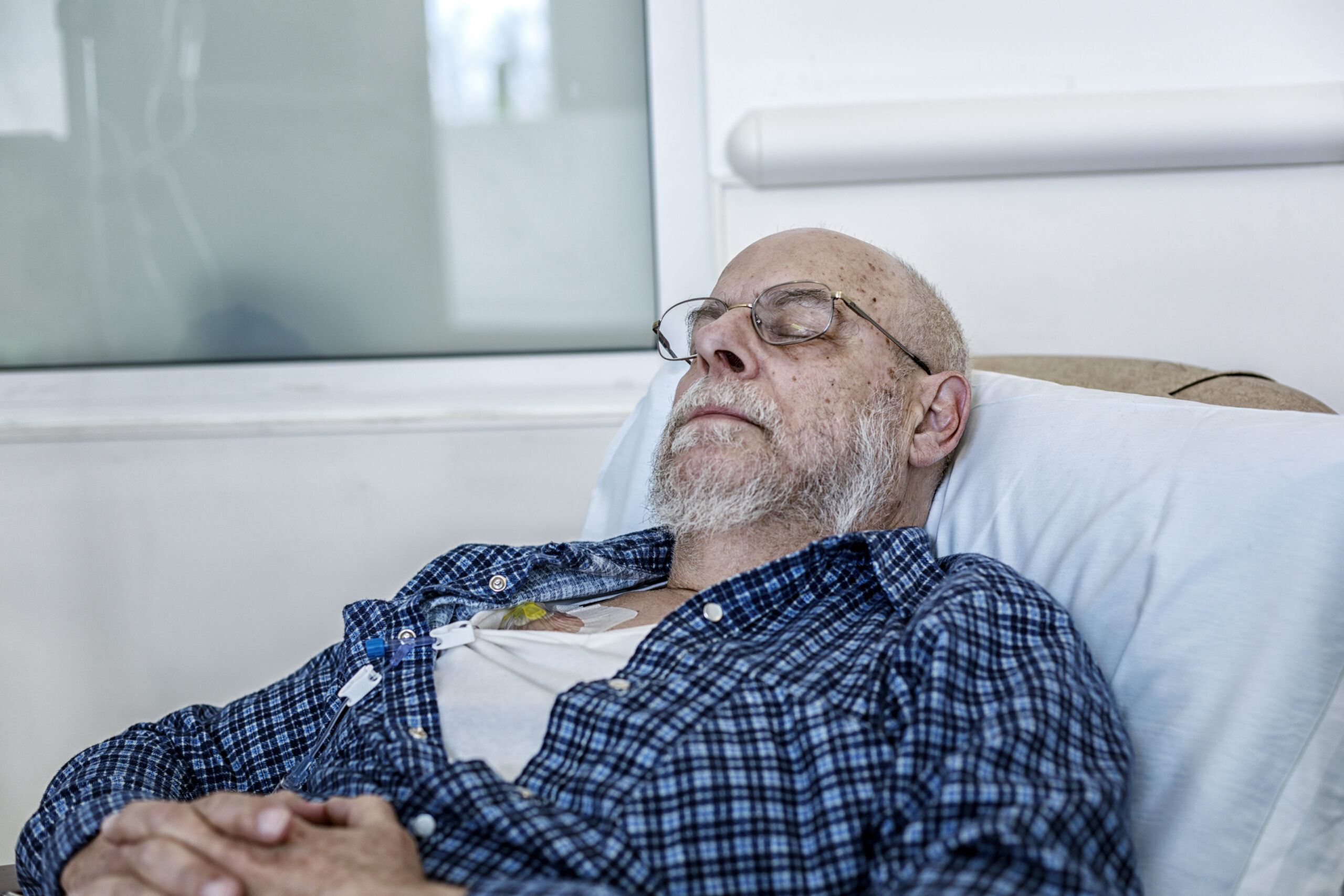 An authentic, real person, senior adult man cancer chemotherapy patient is sleeping - resting comfortably in a hospital outpatient ward as his IV drip continues through his chemo chest port. Many new spots and blemishes have appeared on his skin, and his once-full beard has thinned considerably over the course of the almost concluded three month treatment regime.